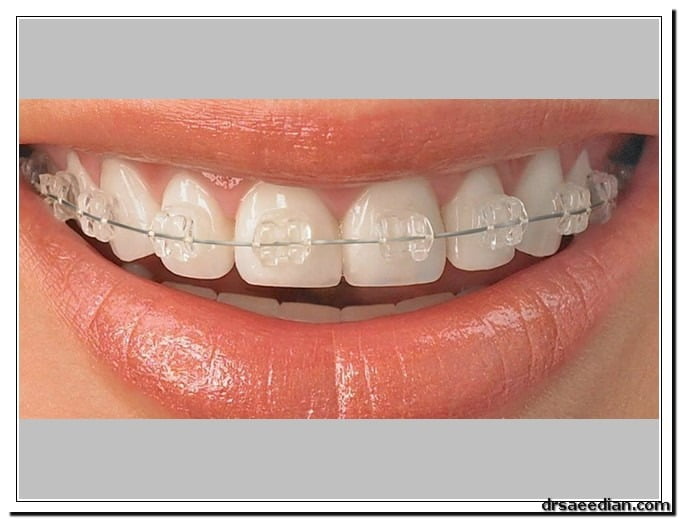 Clear-orthodontics_3.jpg