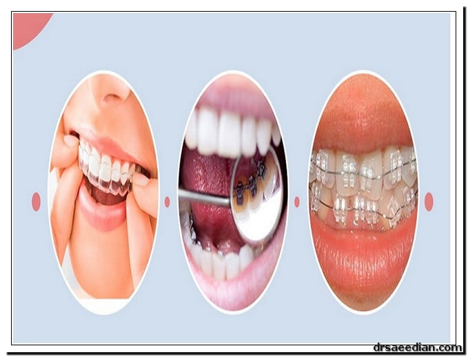 Clear-orthodontics_4.jpg