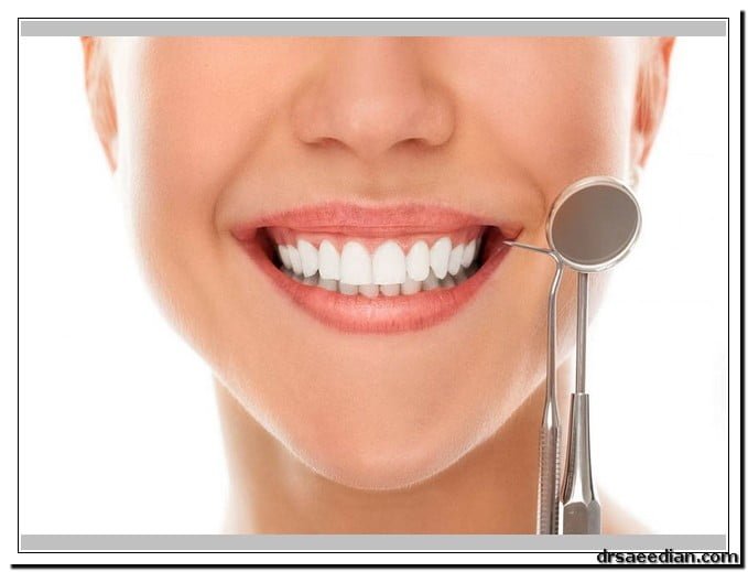 از بین بردن لکه‌های روی دندان