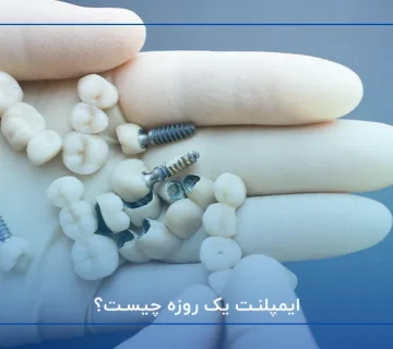 ایمپلنت یک روزه چیست؟