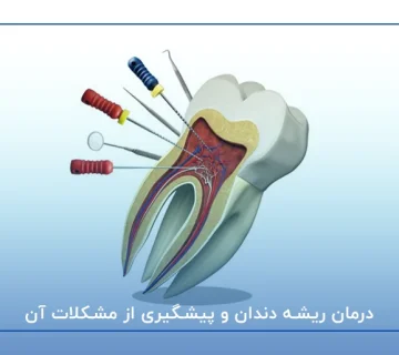درمان ریشه دندان و پیشگیری از مشکلات آن