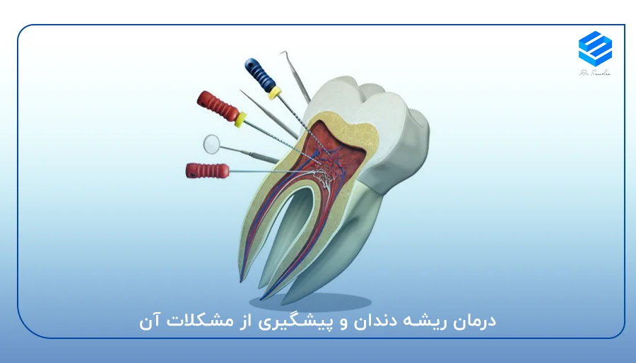 درمان ریشه دندان و پیشگیری از مشکلات آن
