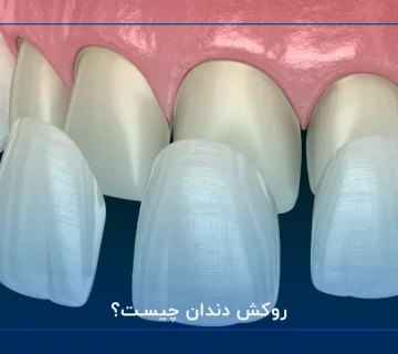 روکش دندان چیست؟
