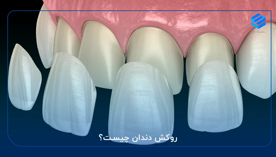 روکش دندان چیست؟