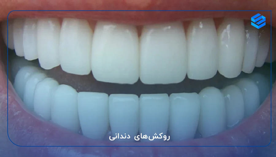 روکش‌های دندانی