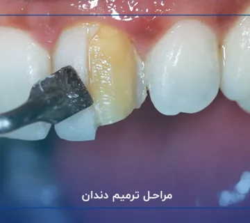مراحل ترمیم دندان