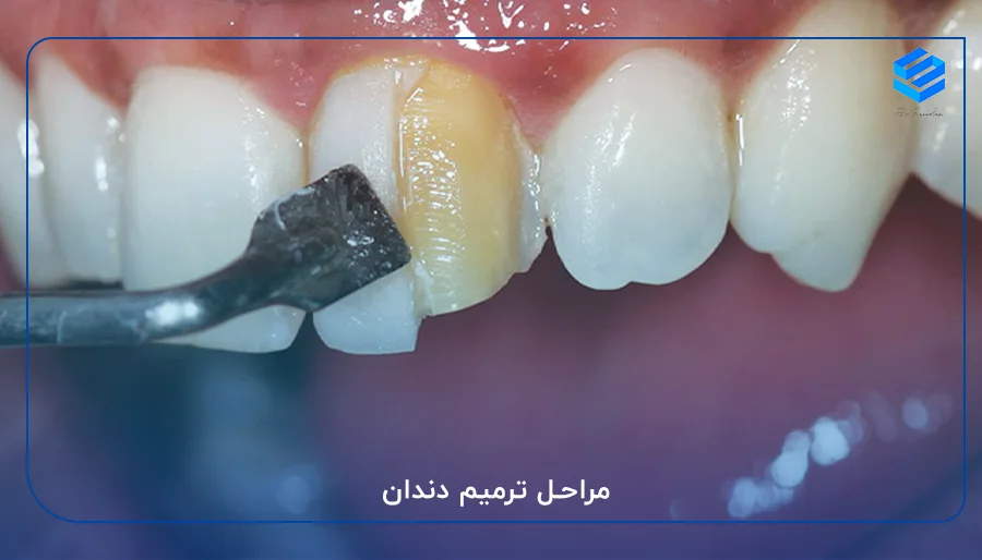 مراحل ترمیم دندان