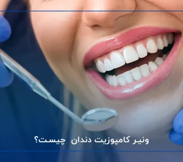 ونیر کامپوزیت دندان چیست؟