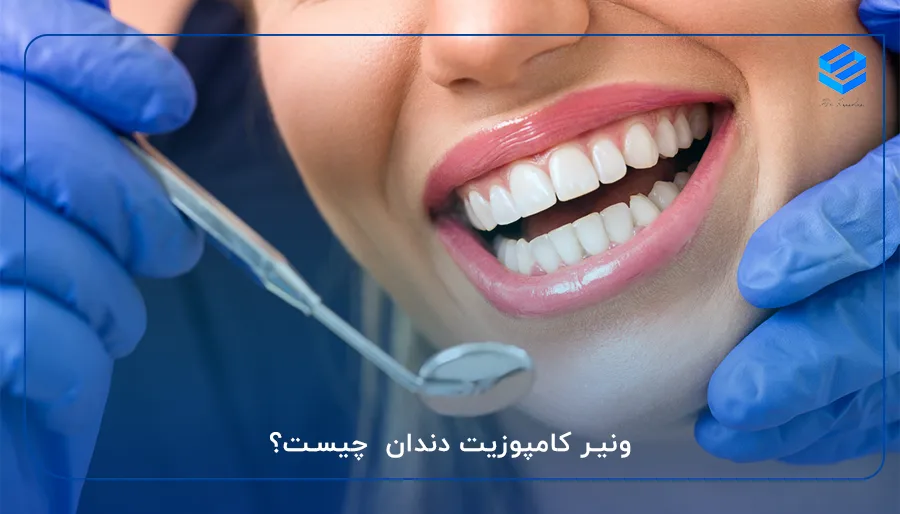 ونیر کامپوزیت دندان چیست؟