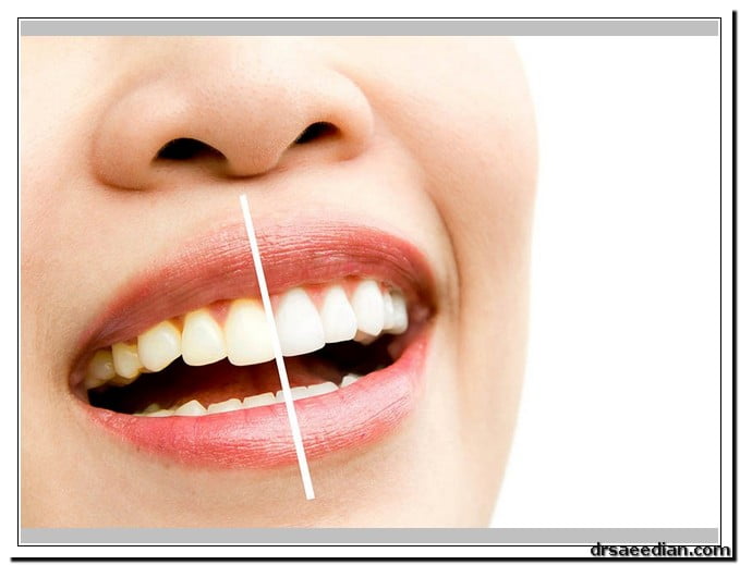 فرق لمینت و کامپوزیت در کلینیک دندانپزشکی دکتر سعیدیان