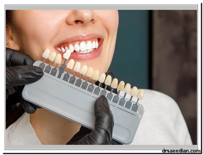 فرق لمینت و کامپوزیت