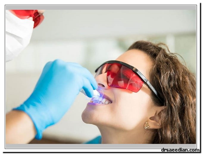 فرق لمینت و کامپوزیت چیست؟