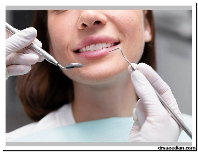 لمینت بهتر است یا کامپوزیت؟