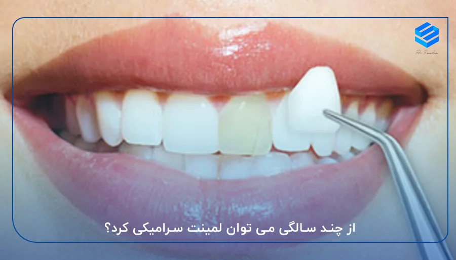 از چند سالگی می توان لمینت سرامیکی کرد؟