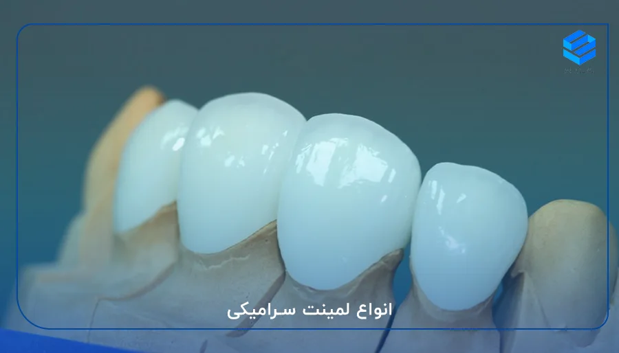 انواع لمینت سرامیکی