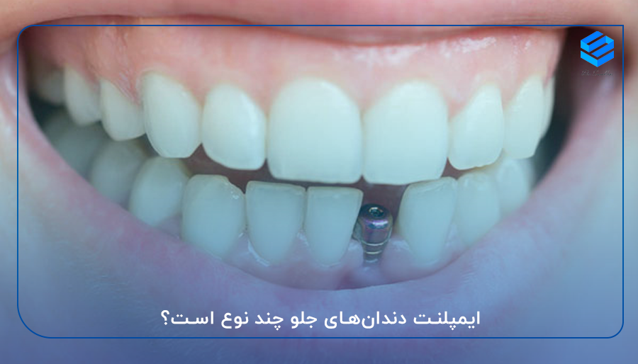 ایمپلنت دندان‌های جلو چند نوع است؟