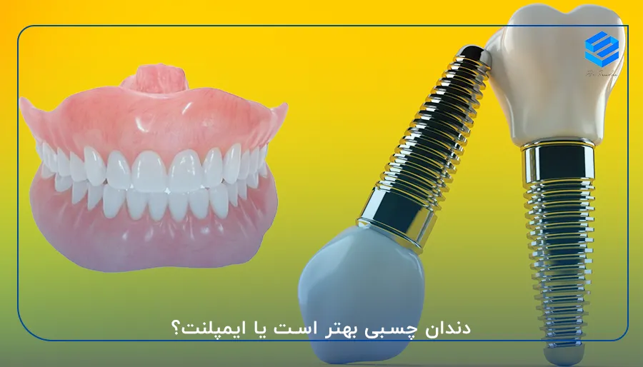دندان چسبی بهتر است یا ایمپلنت؟