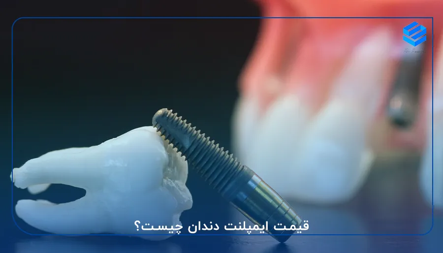 قیمت ایمپلنت دندان چیست؟