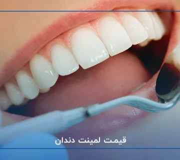 قیمت لمینت دندان در سال 1403
