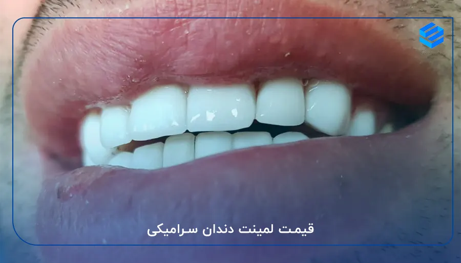 قیمت لمینت دندان سرامیکی