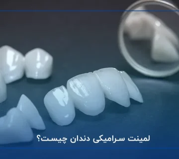 لمینت سرامیکی دندان چیست