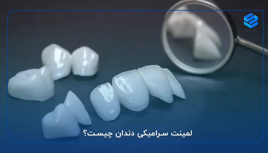 لمینت سرامیکی دندان چیست