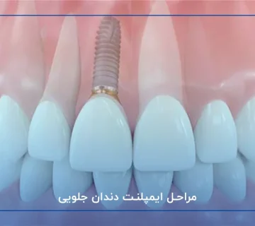 مراحل ایمپلنت دندان جلویی