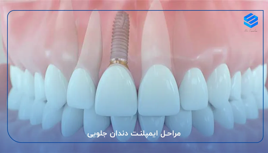 مراحل ایمپلنت دندان جلویی