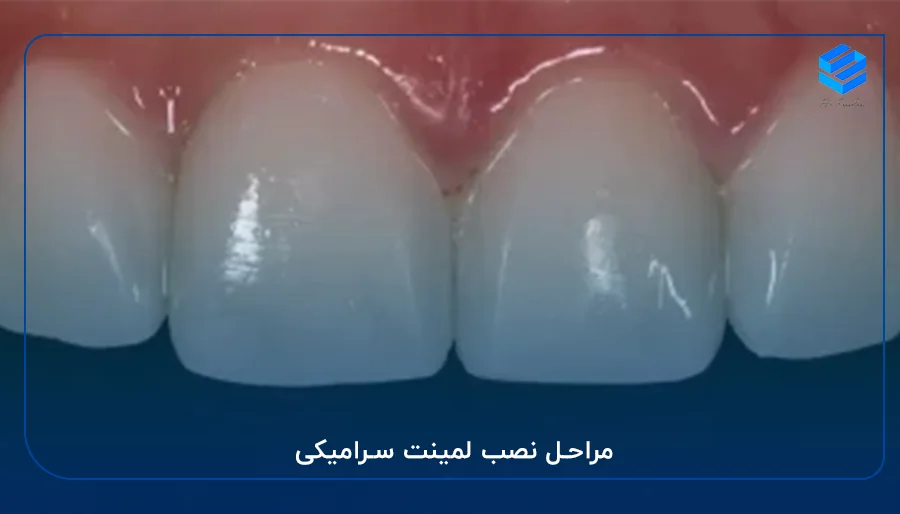 مراحل نصب لمینت سرامیکی