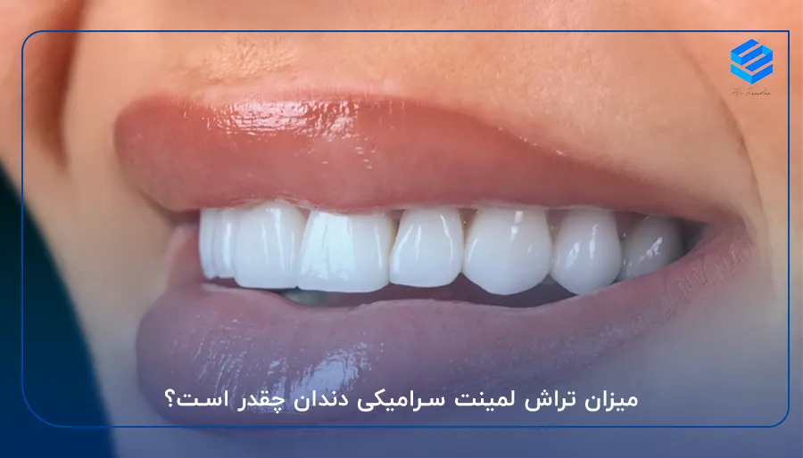 میزان تراش لمینت سرامیکی دندان چقدر است؟