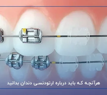 هرآنچه که باید درباره ارتودنسی دندان بدانید