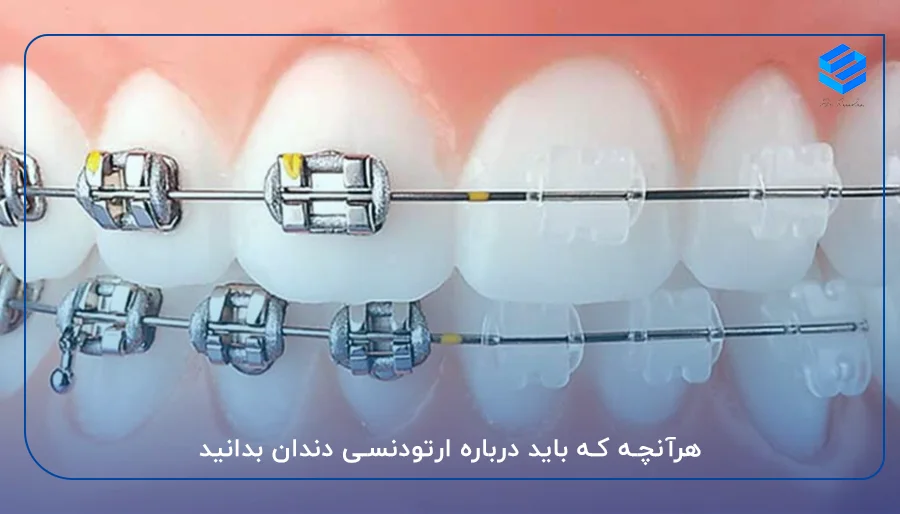 هرآنچه که باید درباره ارتودنسی دندان بدانید