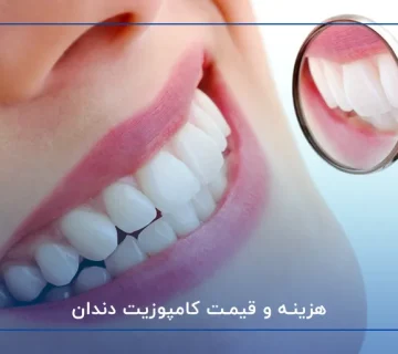 هزینه و قیمت کامپوزیت دندان