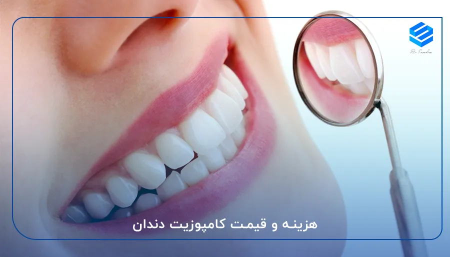 هزینه و قیمت کامپوزیت دندان