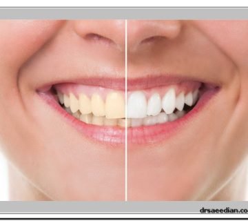 بلیچینگ دندان‌ در کلینیک دندانپزشکی دکتر وحید سعیدیان