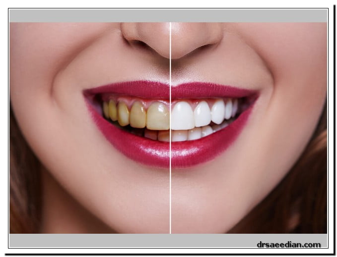 هزینه بلیچینگ دندان 