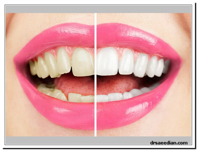 مزایا و معایب و عوارض بلچینگ دندان