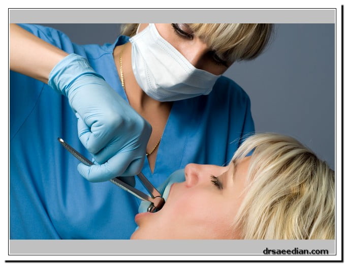 جراحی دندان عقل در کلینیک دندانپزشکی دکتر وحید سعیدیان
