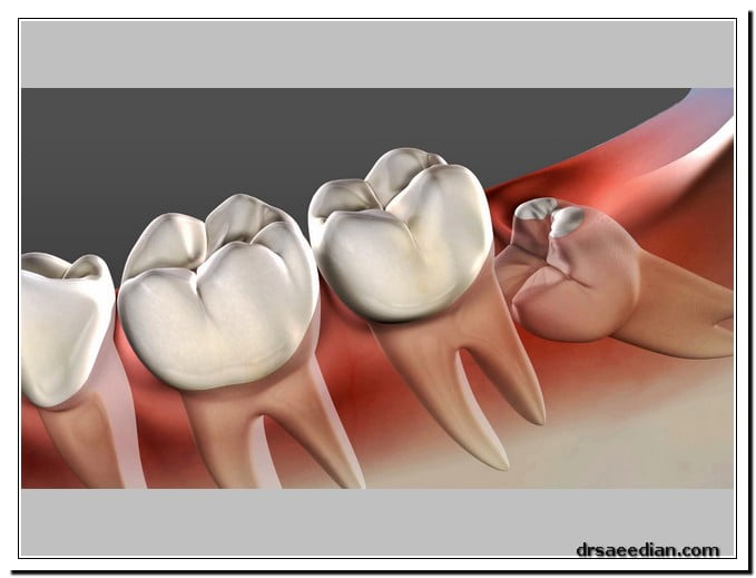 عفونت و عوارض ناشی از جراحی دندان عقل نهفته