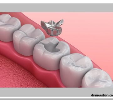 پر کردن دندان در کلینیک دندانپزشکی دکتر وحید سعیدیان