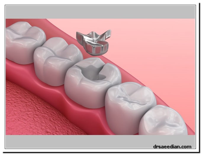 پر کردن دندان در کلینیک دندانپزشکی دکتر وحید سعیدیان