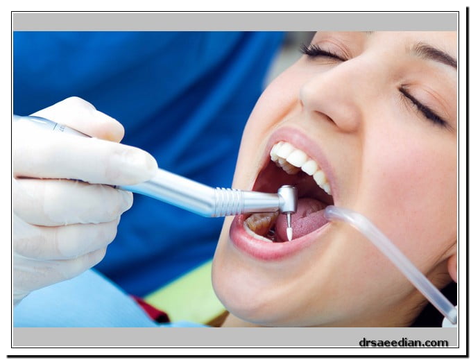 چه زمانی اقدام به پر کردن دندان ها کنیم؟