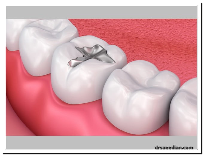 انواع مواد پر کردن دندان