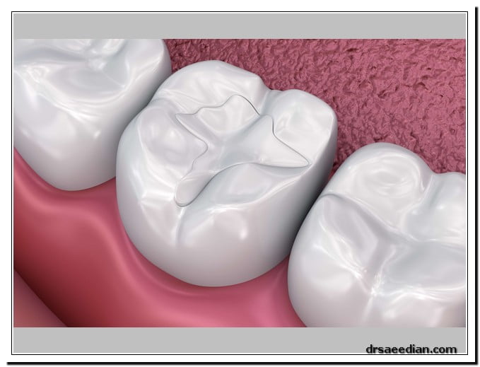 هزینه پرکردن دندان