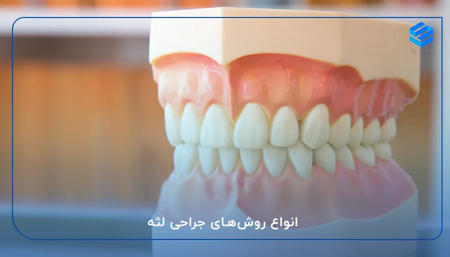 انواع روش‌های جراحی لثه