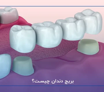 بریج دندان چیست؟