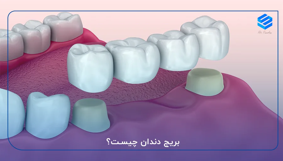 بریج دندان چیست؟