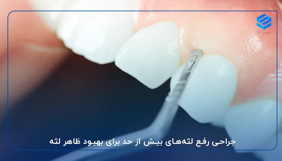 جراحی رفع لثه‌های بیش از حد برای بهبود ظاهر لثه