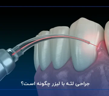 جراحی لثه با لیزر چگونه است؟
