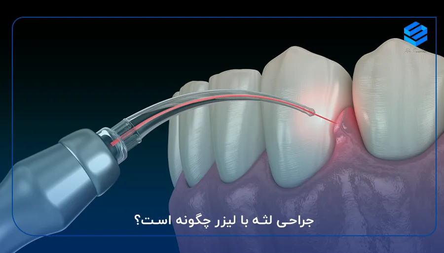 جراحی لثه با لیزر چگونه است؟